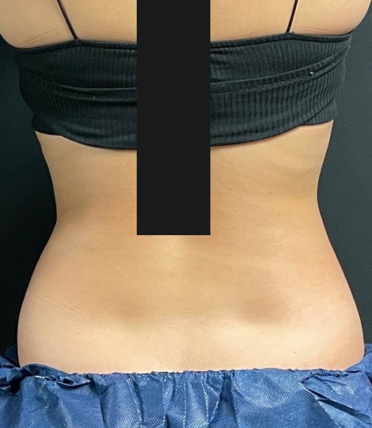 After Image: CoolSculpting - back