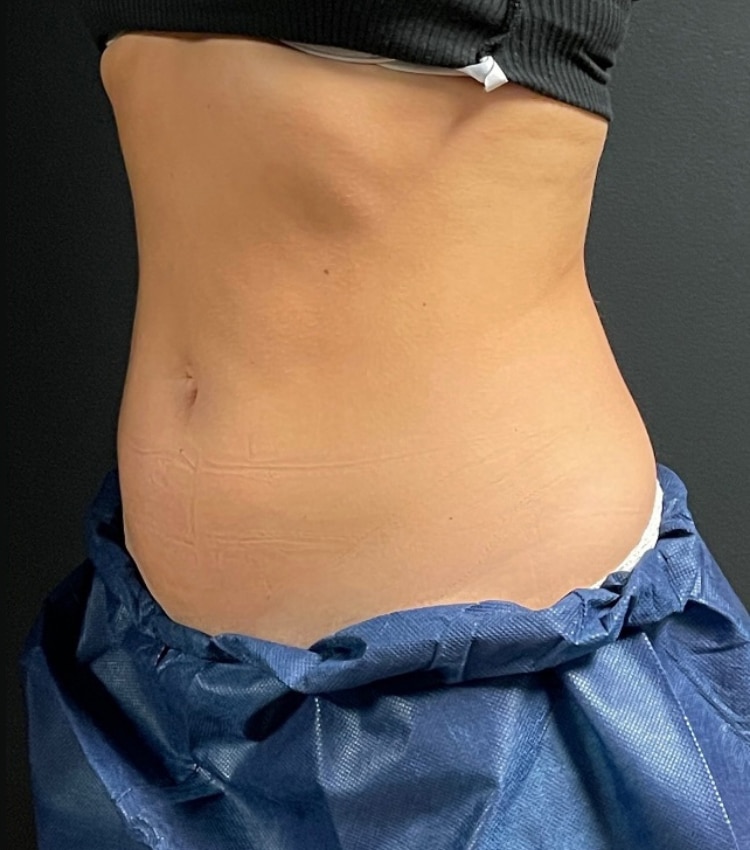 After Image: CoolSculpting - left-front-oblique