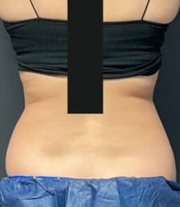 Before Image: CoolSculpting