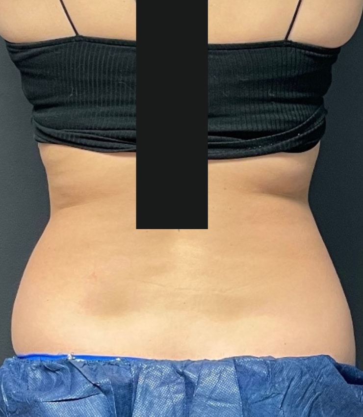 Before Image: CoolSculpting - back