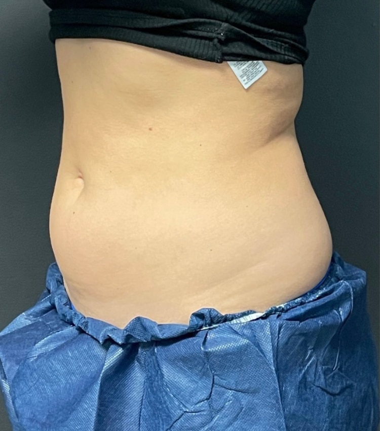Before Image: CoolSculpting - left-front-oblique