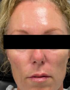 Botox and Filler