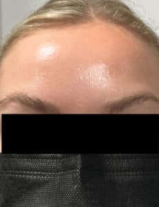 After Image: Botox
