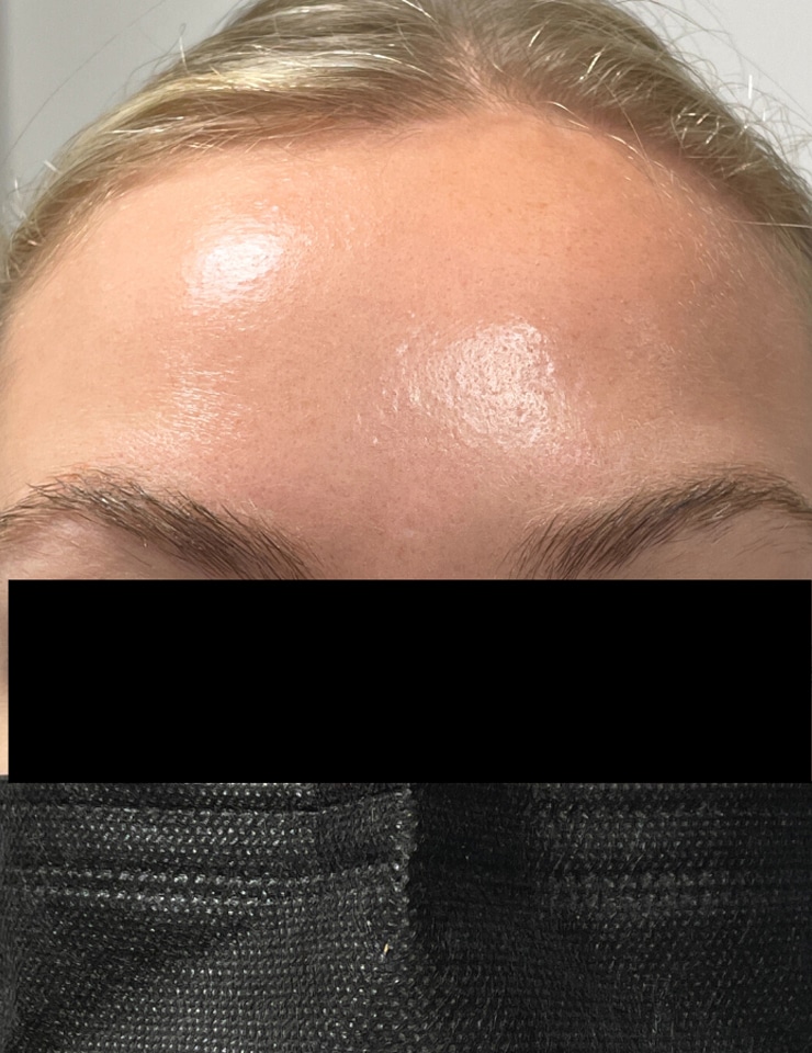 After Image: Botox - front
