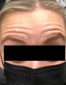 Before Image: Botox