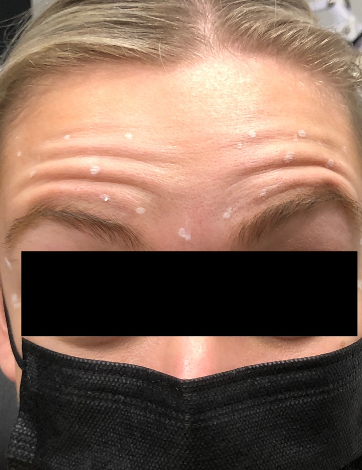 Before Image: Botox - front