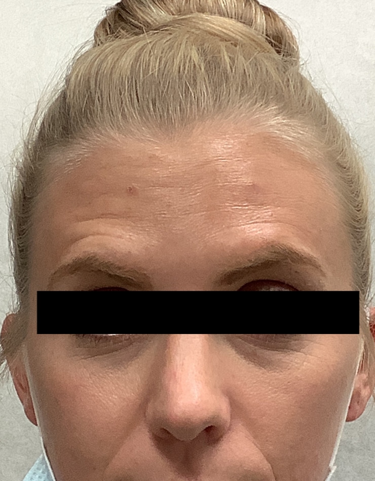 After Image: Botox - front