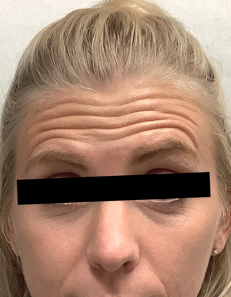 Before Image: Botox - front