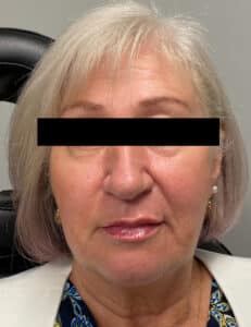 After Image: Botox and Filler