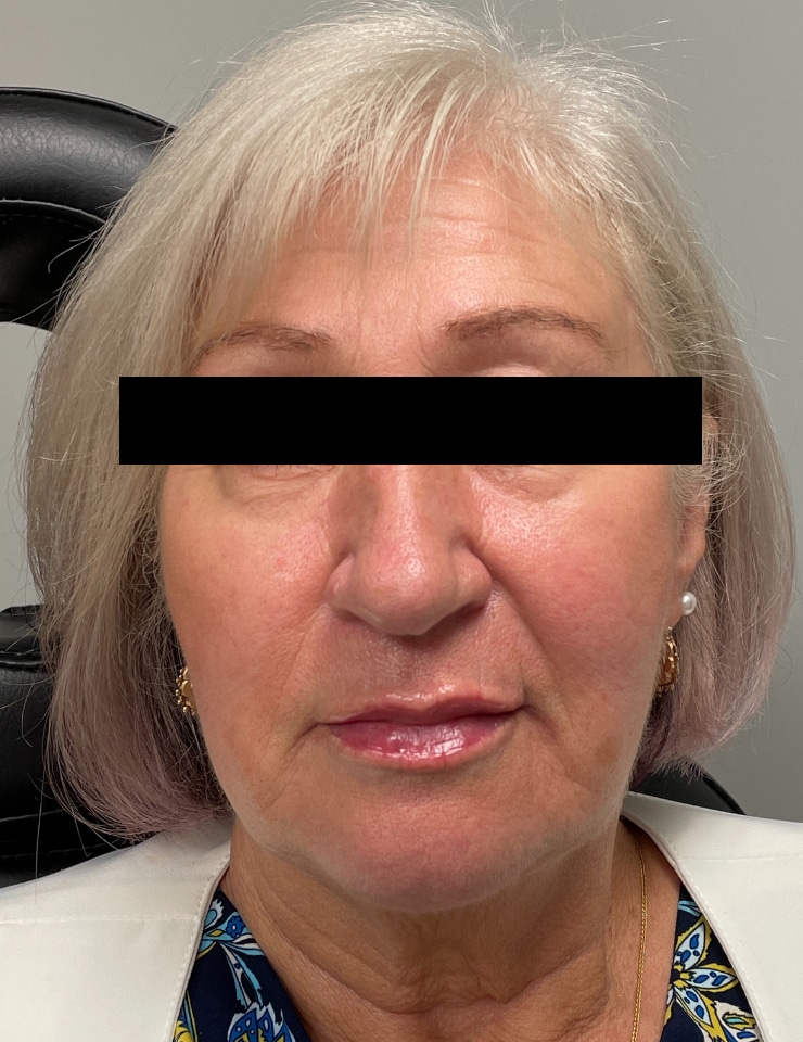 After Image: Botox and Filler - front
