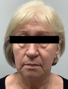Before Image: Botox and Filler