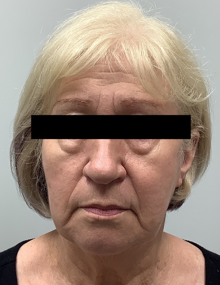 Before Image: Botox and Filler - front
