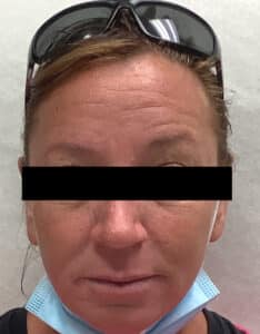 Before Image: Filler