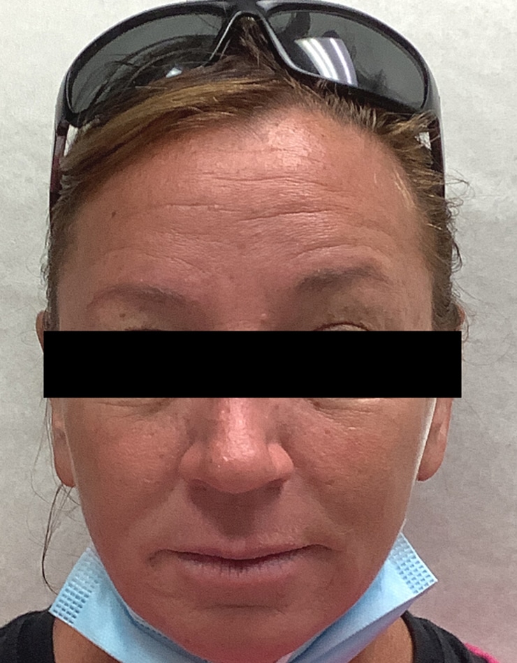 Before Image: Filler - front