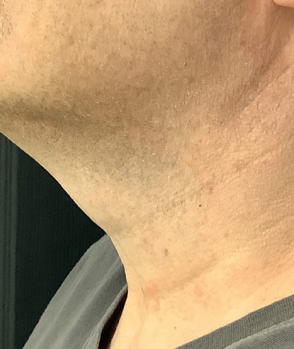 After Image: ResurFX - left-side