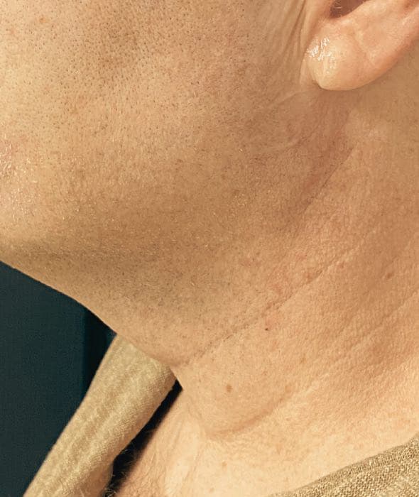 Before Image: ResurFX - left-side