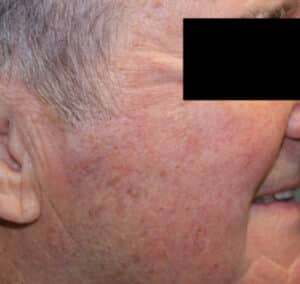 After Image: Skin Lesion Removal