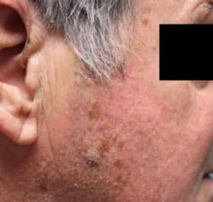 Before Image: Skin Lesion Removal