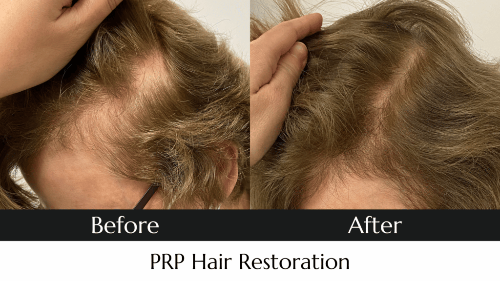 Before and after photo of PRP Hair Restoration Treatment at MedAesthetics in Sarnia.