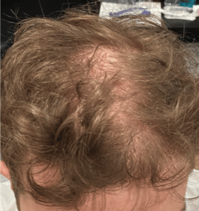 Before Image: PRP Hair Restoration – Male