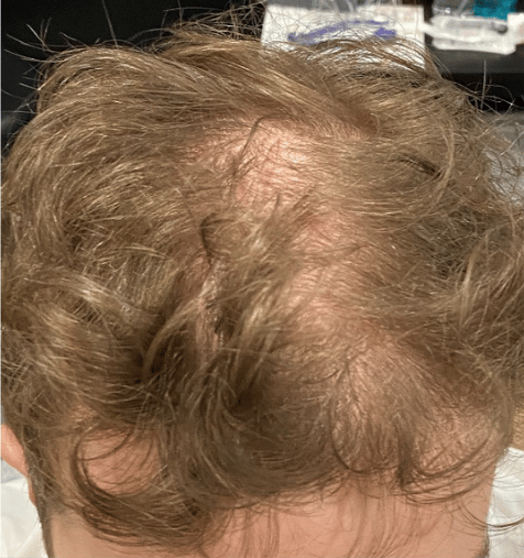 Before Image: PRP Hair Restoration – Male - front