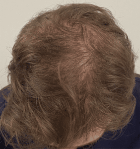After Image: PRP Hair Restoration – Male
