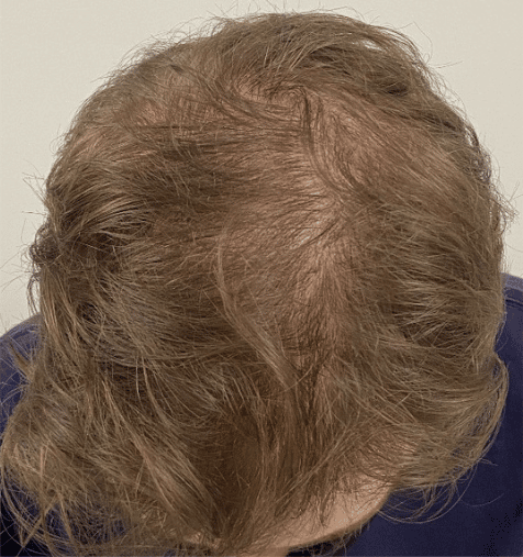 After Image: PRP Hair Restoration – Male - front