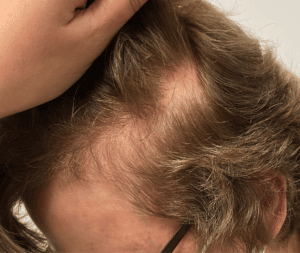 Before Image: PRP Hair Restoration – Female