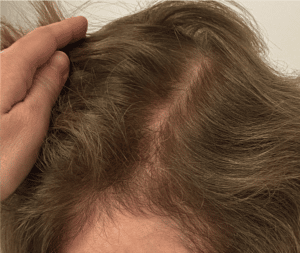 After Image: PRP Hair Restoration – Female