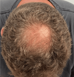 Before Image: PRP Hair Restoration – Male
