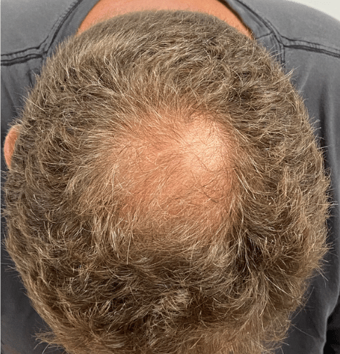 Before Image: PRP Hair Restoration – Male - front