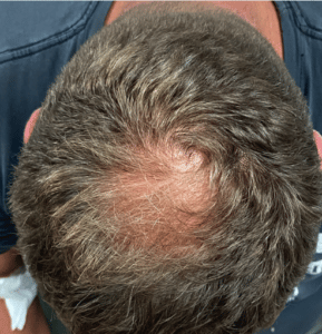 After Image: PRP Hair Restoration – Male
