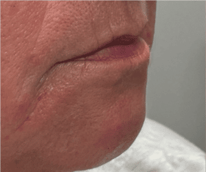 Before Image: Juvederm Filler – Lips