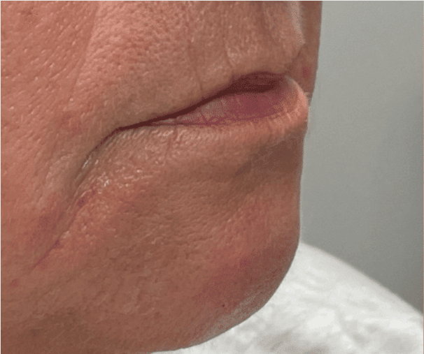 Before Image: Juvederm Filler – Lips - right-front-oblique