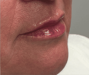 After Image: Juvederm Filler – Lips