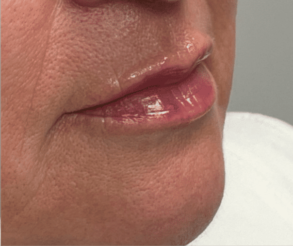After Image: Juvederm Filler – Lips - right-front-oblique