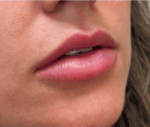 Before Image: Juvederm Filler – Lips