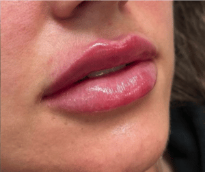 After Image: Juvederm Filler – Lips