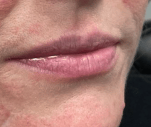 Before Image: Juvederm Filler – Lips