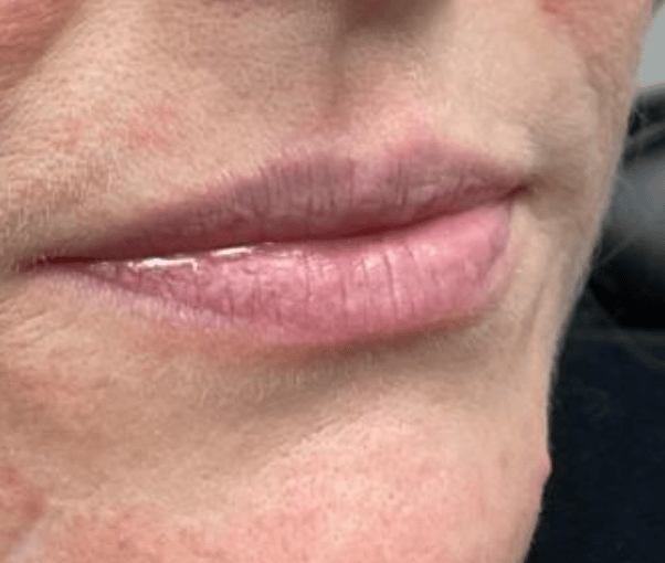 Before Image: Juvederm Filler – Lips - front