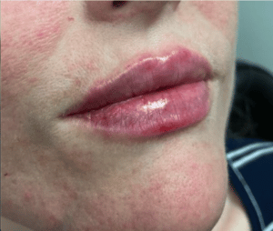 After Image: Juvederm Filler – Lips