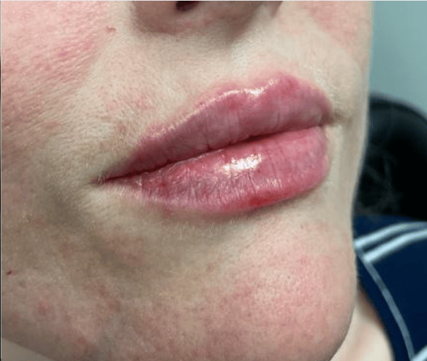 After Image: Juvederm Filler – Lips - front