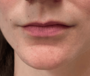 Before Image: Juvederm Filler – Lips