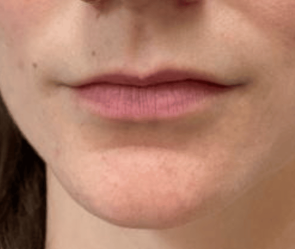 Before Image: Juvederm Filler – Lips - front