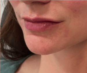 After Image: Juvederm Filler – Lips