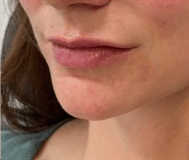 After Image: Juvederm Filler – Lips - front