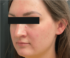 Before Image: Microneedling – Acne Scars & Skin Complexion