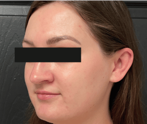 After Image: Microneedling – Acne Scars & Skin Complexion