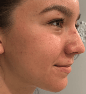 Before Image: Microneedling