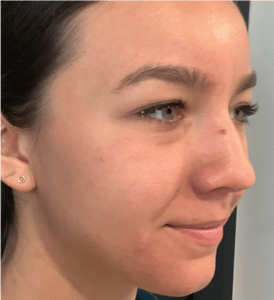 After Image: Microneedling